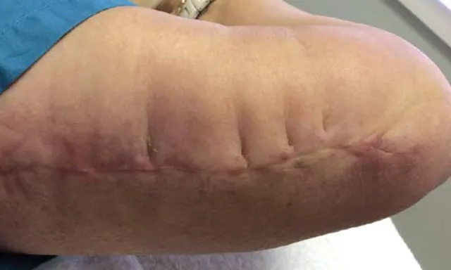 Tratamiento de Cicatrices