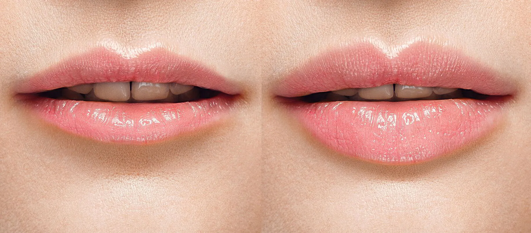 Aumento de labios - ABB Medicina Estética