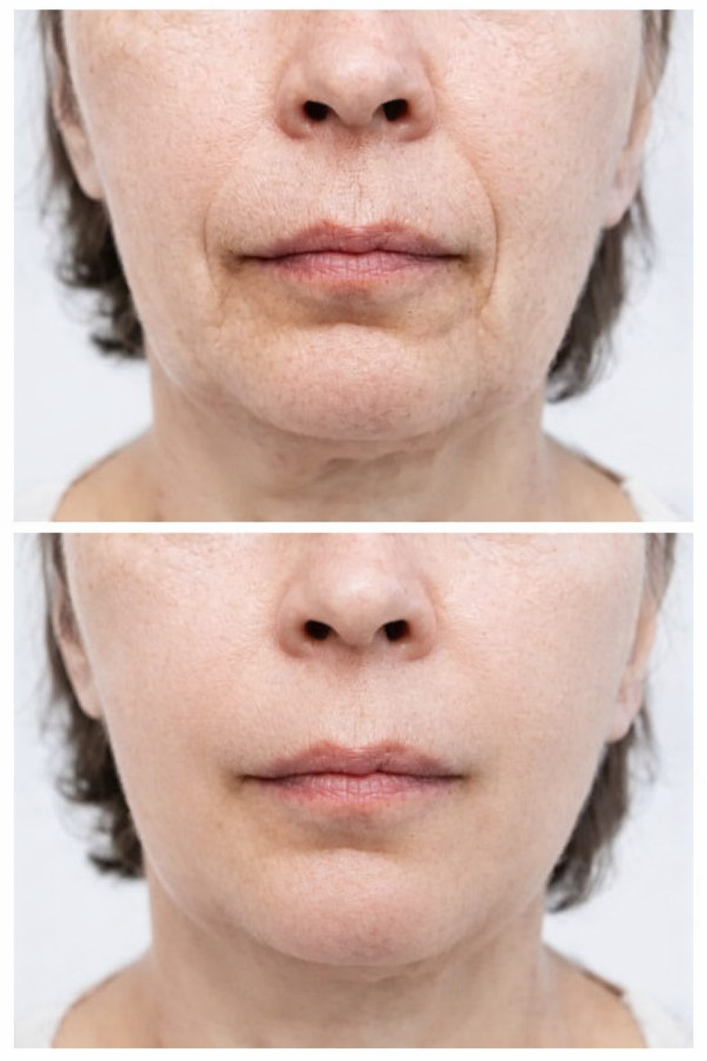 Flacidez facial - antes y después