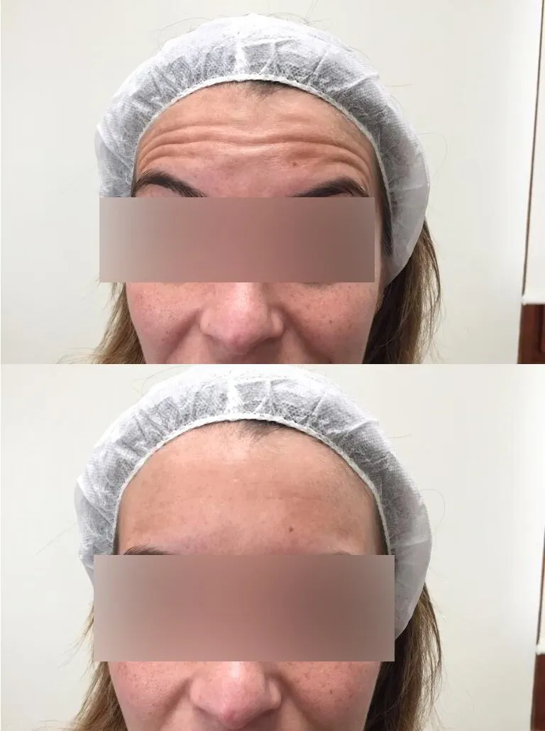 Arrugas de Expresión