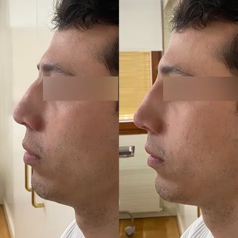 Rinomodelación - antes y después