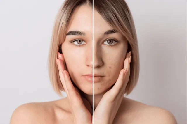 Indiba - Rejuvenecimiento