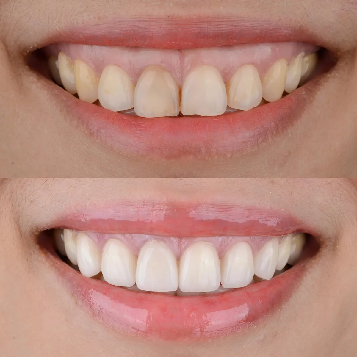 Sonrisa gingival