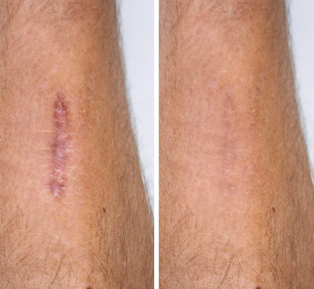 Tratamiento de Cicatrices